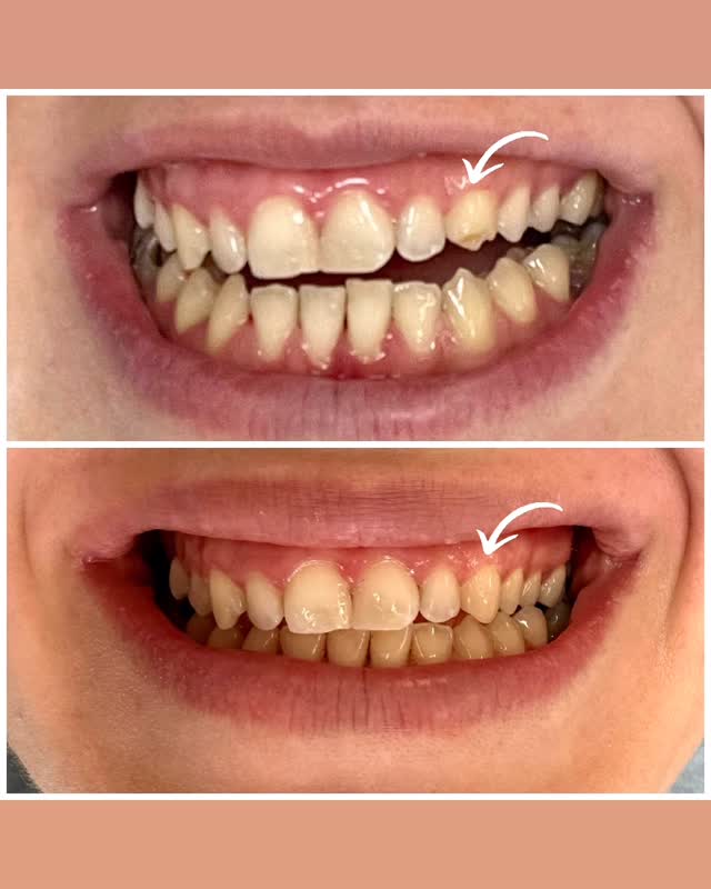 Dental Alignment — before