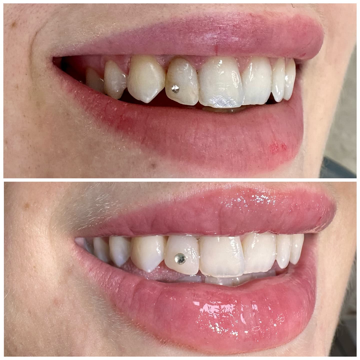 Composite Restoration — before