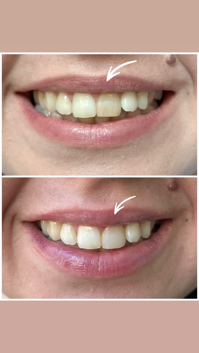 Whitening & Composite — before