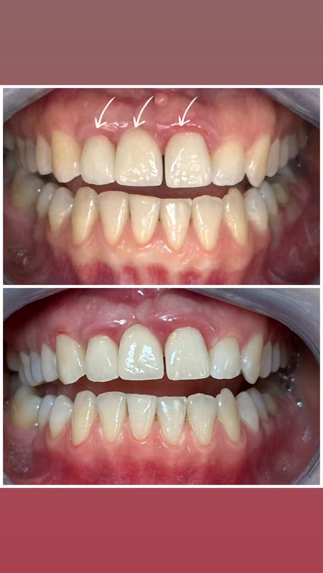 Crown & Periodontal — before